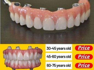 Full Mouth Dental Implants Price