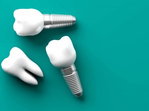 Affordable Dental Implant For Seniors