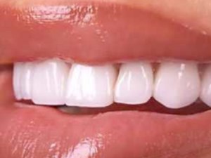 Clear Choice Dental Implants Price