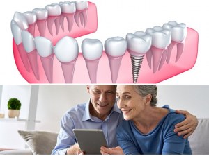 Affordable Full Mouth Dental Implants