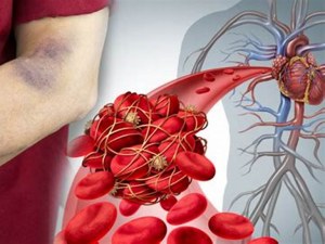 What Is Amyloidosis And What Causes It