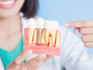 Dental Implant Costs For Seniors