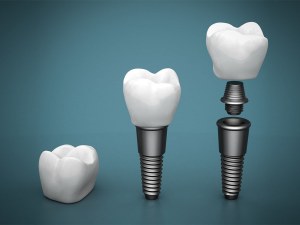 Dental Implants Full Mouth Near Me Prices