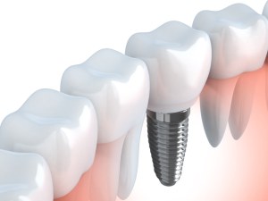 Funding For Dental Implants
