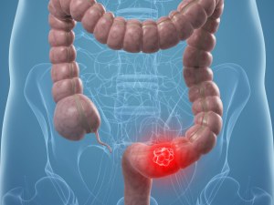 Symptoms Colon