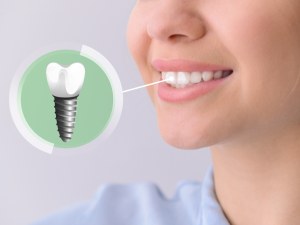 Dental Implants Seniors