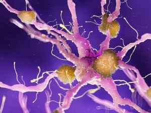 Ascvd Amyloidosis Treatment