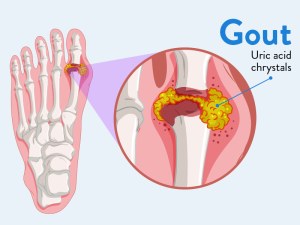 Gout Signs And Symptoms
