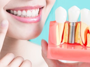 Full Mouth Dental Implant Price List